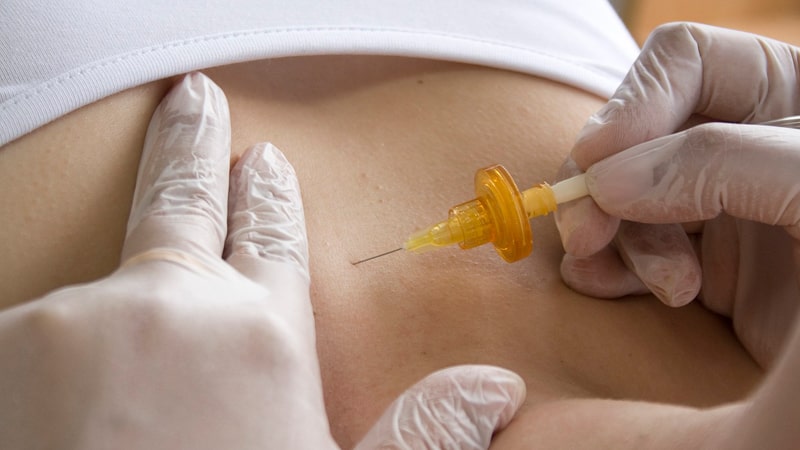 Tratamiento de carboxiterapia