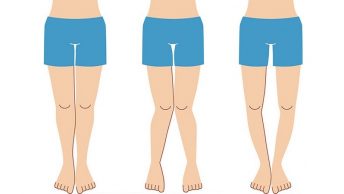 Alineación de piernas y cadera