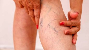 varices-pierna-min