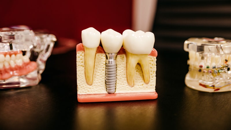Maquetas de tratamientos dentales