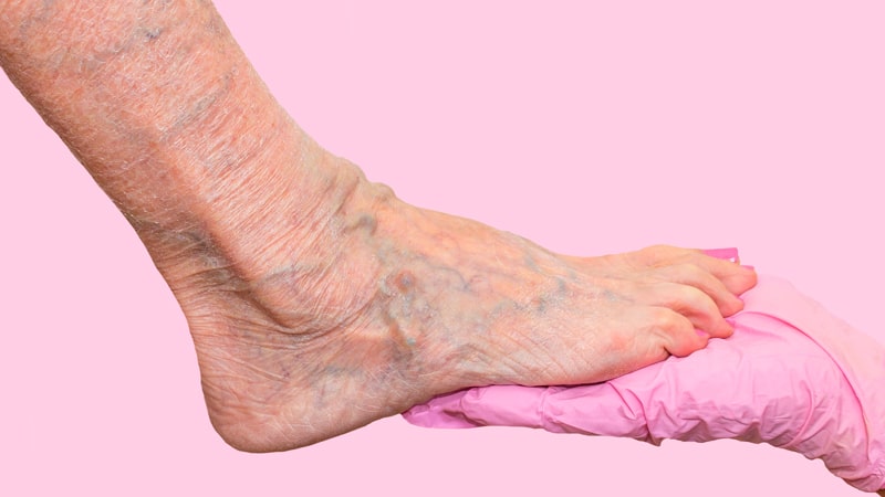 Pierna de mujer mayor llena de varices