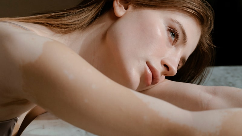 Causas y tratamientos para decoloración de la piel 1 Mujer con vitiligo