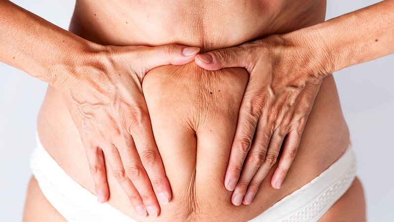 Mujer con flacidez corporal