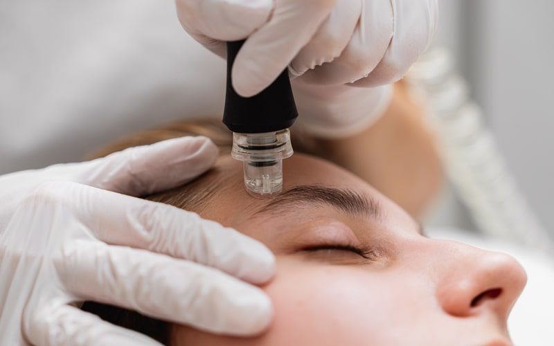 Peeling químico vs. microdermoabrasión: ¿cuál es mejor para tratar manchas oscuras? 1 Microdermoabrasión