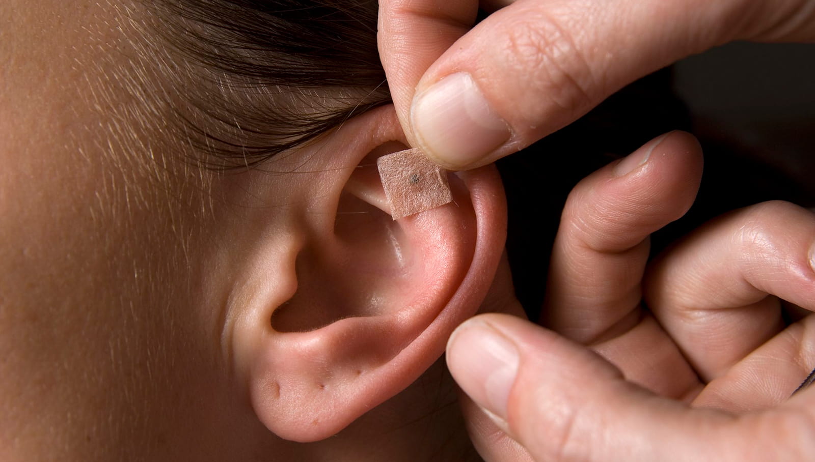 Auriculoterapia