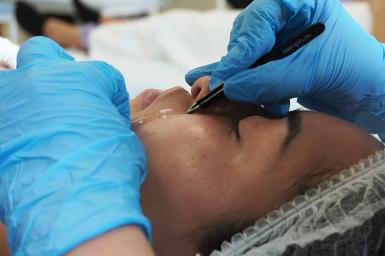 Hilos tensores reabsorbibles