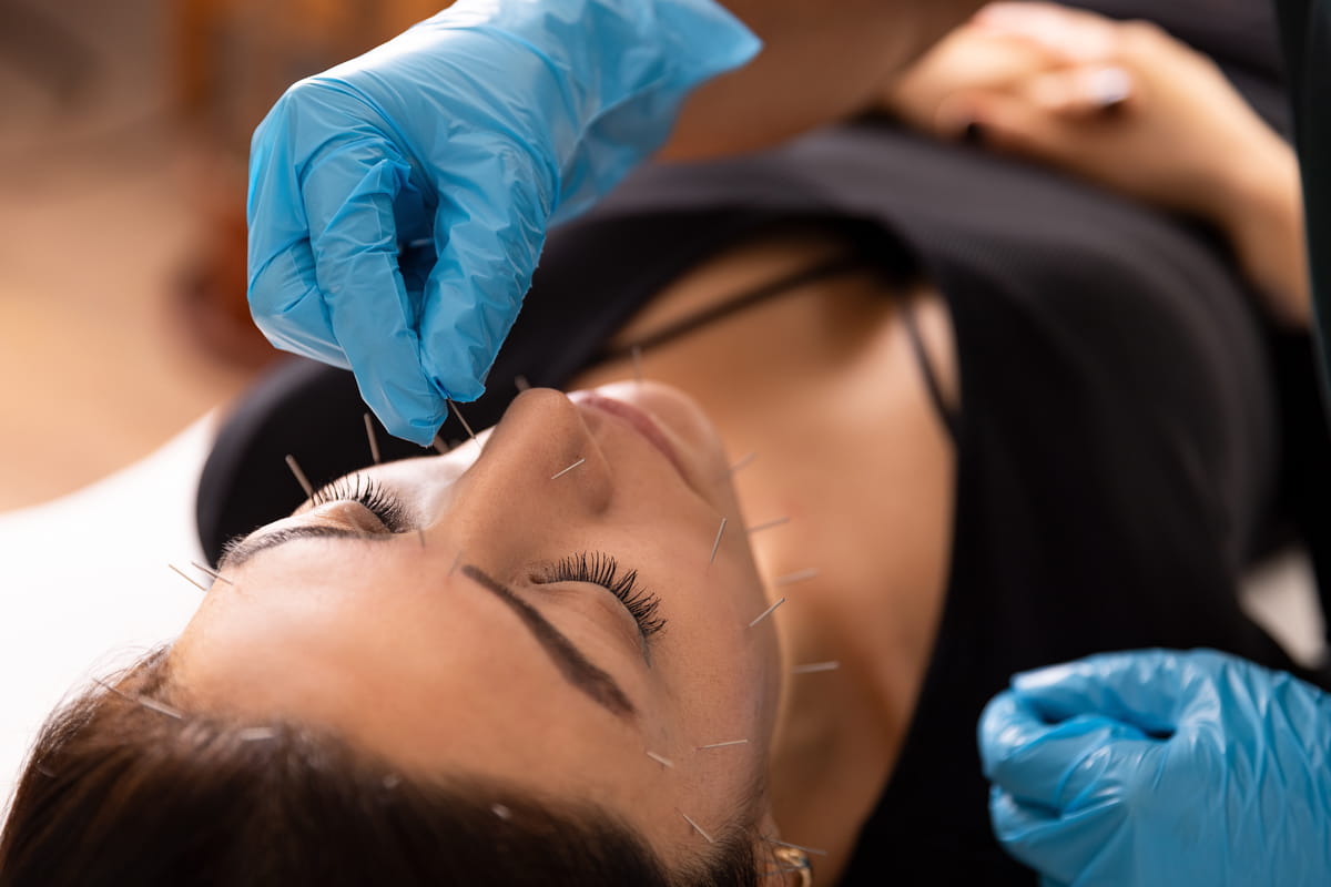 Lifting acupuntura facial