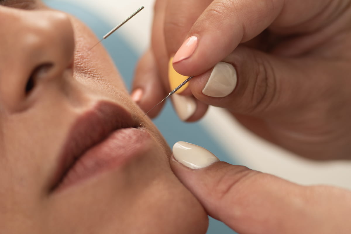 Lifting acupuntura facial