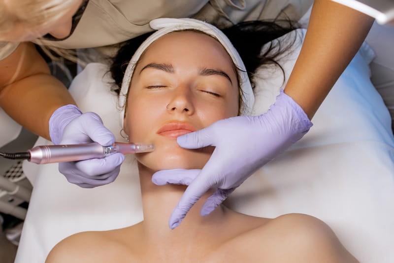 Microneedling